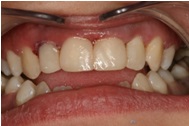 zęby po leczeniu stomatologicznym