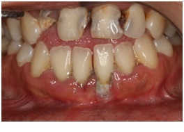 zęby przed leczeniem stomatologicznym