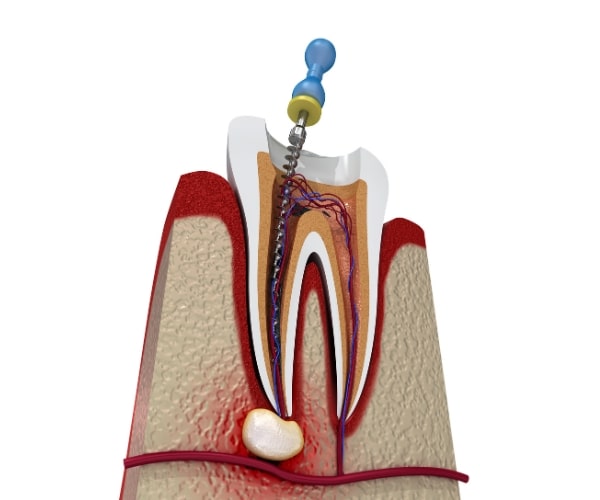 leczenie endodontyczne zęba