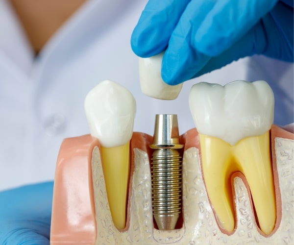 implant zęba kompleksowe leczenie